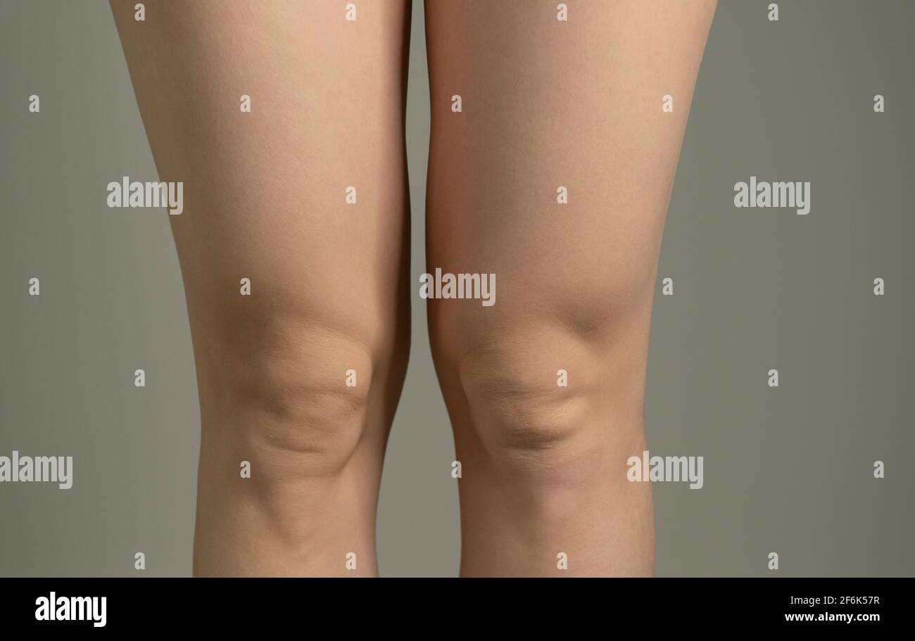 Overweight fat above knees of skinny fat figured woman. Woman`s hips